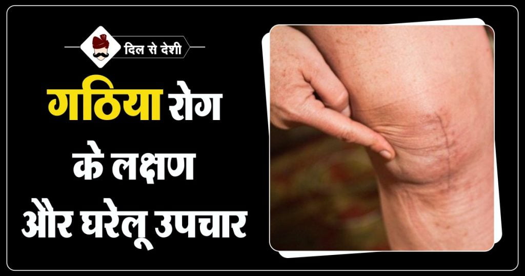 Gathiya Disease Symptoms and Home Remedy in Hindi
