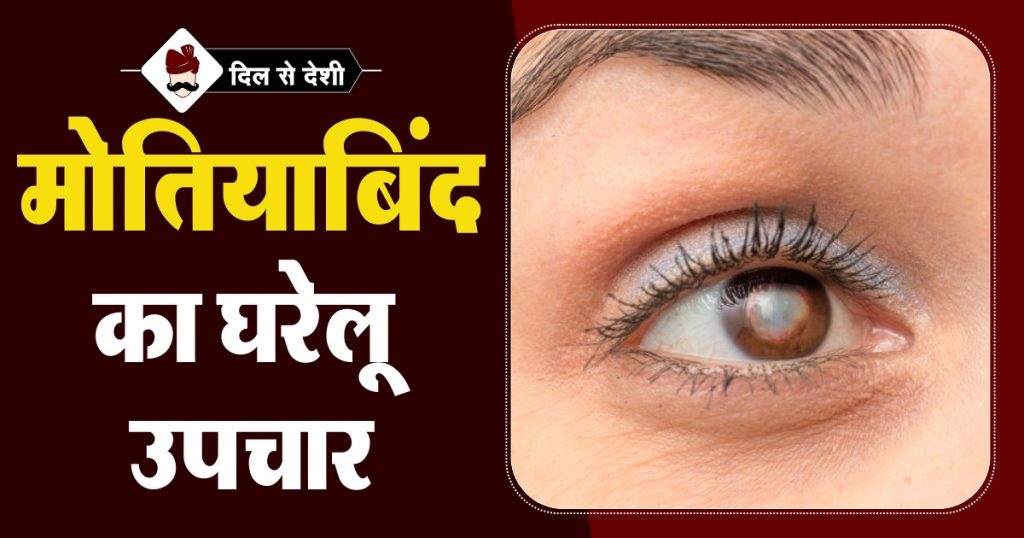 Cataracts Home Remedies Treatment in Hindi
